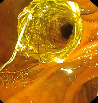 Нитиноловый саморасширяющийся стент холедоха.. Атлас эндоскопических изображений endoatlas